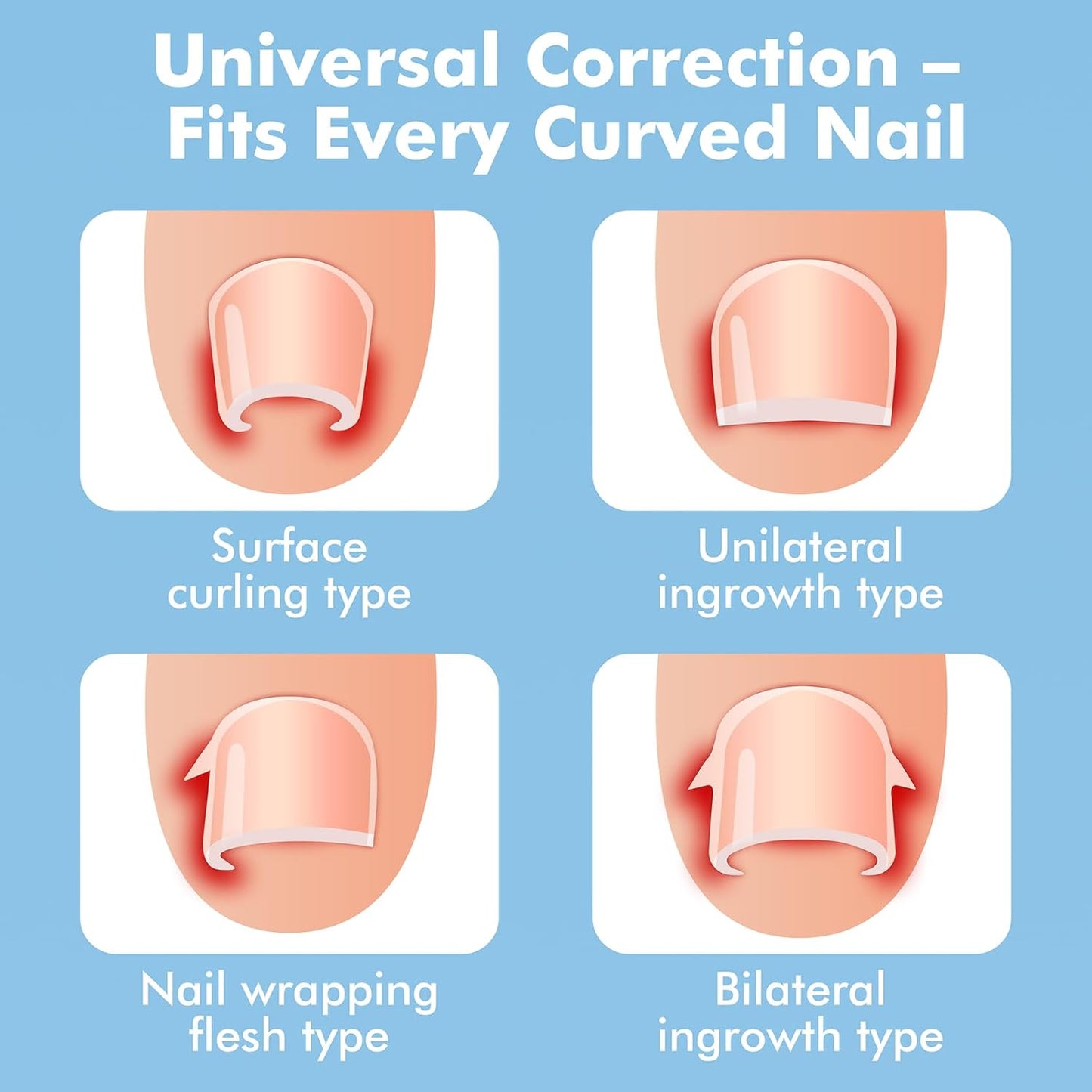 Ingrown Toenail Removal Kit – At-Home Nail Brace for Pain Relief & Correction