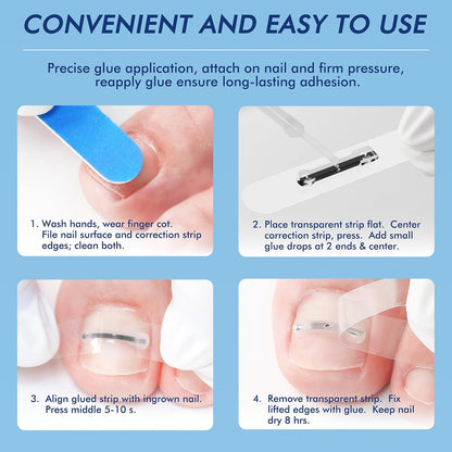 Ingrown Toenail Removal Kit – At-Home Nail Brace for Pain Relief & Correction